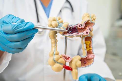 Colonoscopia detección de cancer (1) La colonoscopía es un procedimiento médico endoscópico que permite al Dr. Bernardo Amador visualizar el interior de todo el intestino grueso (colon) y la parte final del intestino delgado (íleon terminal). Se realiza mediante un colonoscopio, un tubo largo, delgado y flexible que cuenta con una luz y una pequeña cámara de vídeo de alta resolución en su extremo. Este instrumento se introduce suavemente a través del ano del paciente y se avanza lentamente a través del recto y el colon, permitiendo una inspección detallada del revestimiento interno de estas estructuras.