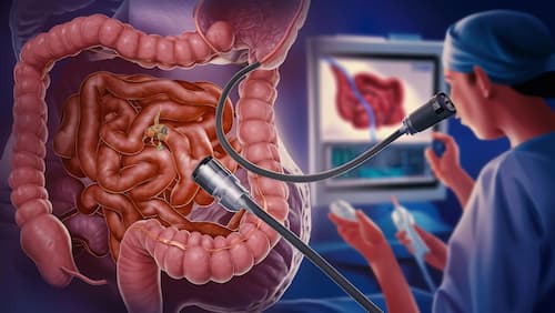 Colonoscopía intestinal Colonoscopía: La Clave para la Detección y Prevención del Cáncer de Colon
